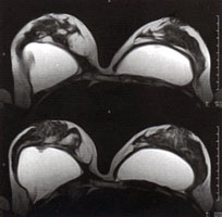 MRI of breast implants