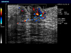 With color visualization, this image shows the small superficial vessels of the nipple.