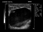 Large cyst with layered debris and a solid component.