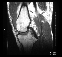 Knee MRI