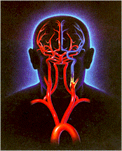 Stroke in the left carotid artery (yellow region)